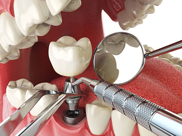Best Emergency Treatment for Toothache in Belle, MO